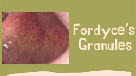 grain de fordyce|Grains de Fordyce : faut